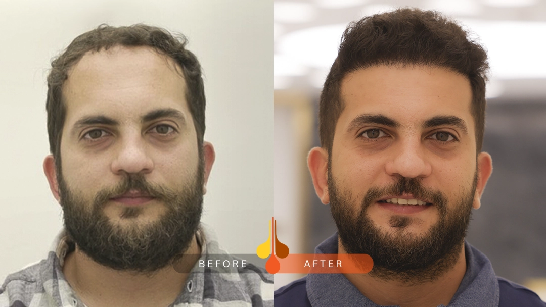 Natural hair transplant results in Dubai at Padra Clinic