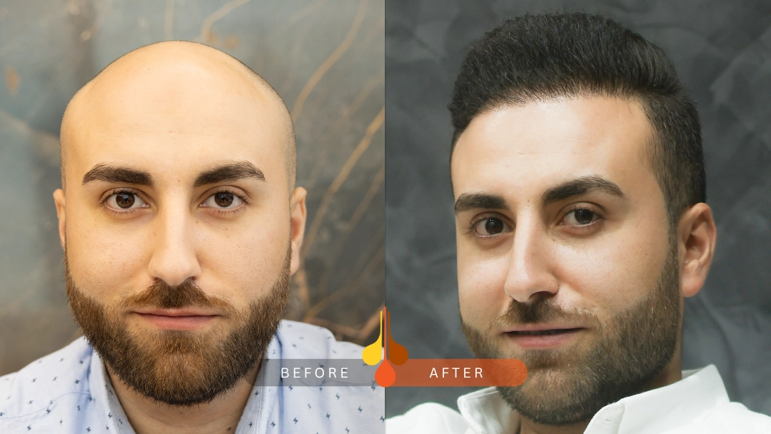 Before and after hair transplant at Padra Clinic Dubai