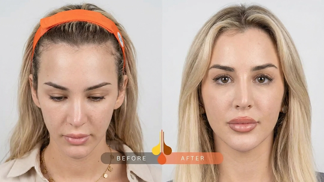 Natural women's hair transplant results in Saudi Arabia