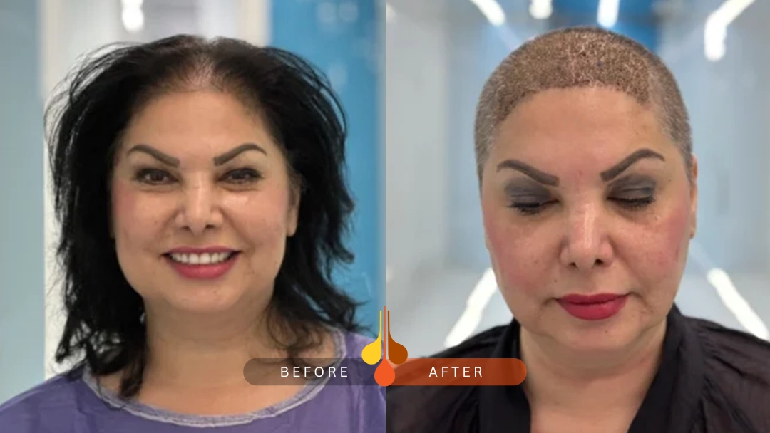 before and after pics of hair transplant - women