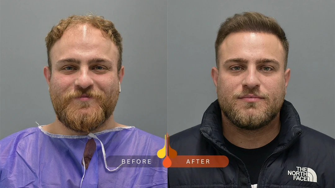 Natural hair transplant transformation at Padra Clinic Saudi Arabia