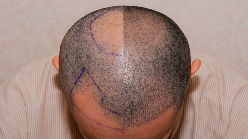 hair transplantation after 2 month