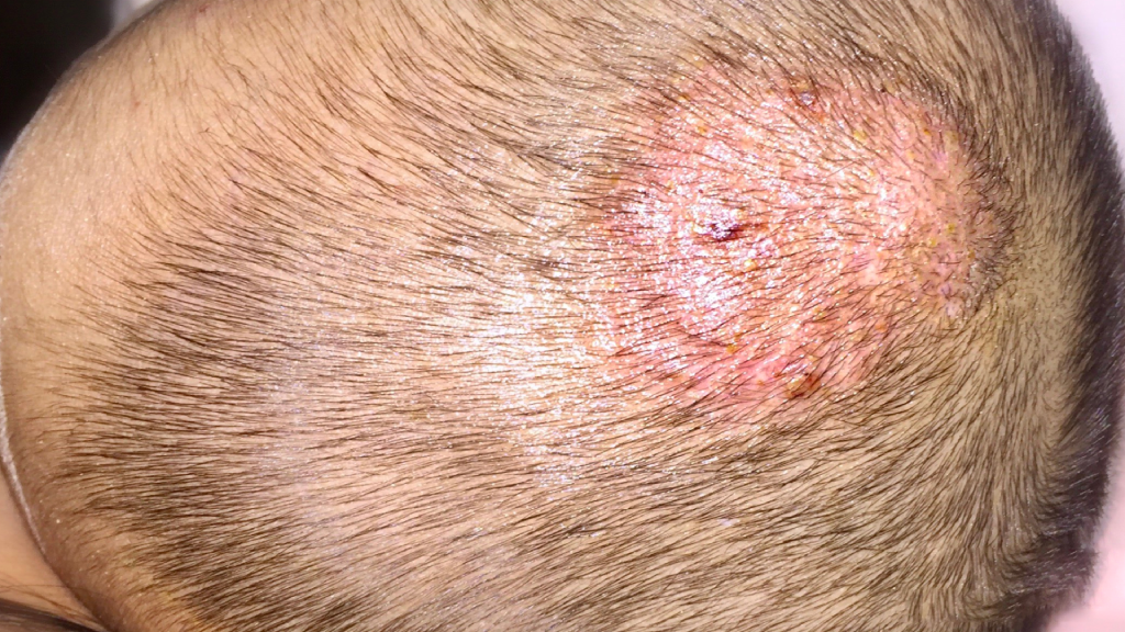 التهاب فروة الراس بعد زراعة الشعر 