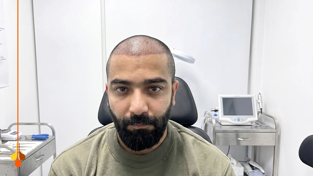 بعد 10 أيام من زراعة الشعر
