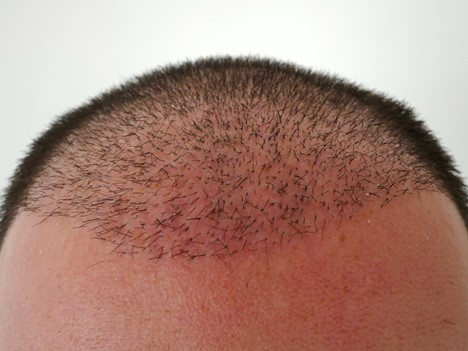 كيف يبدوا الشعر شهرين بعد زراعة الشعر 
