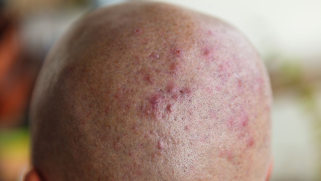 Boils after hair transplantation