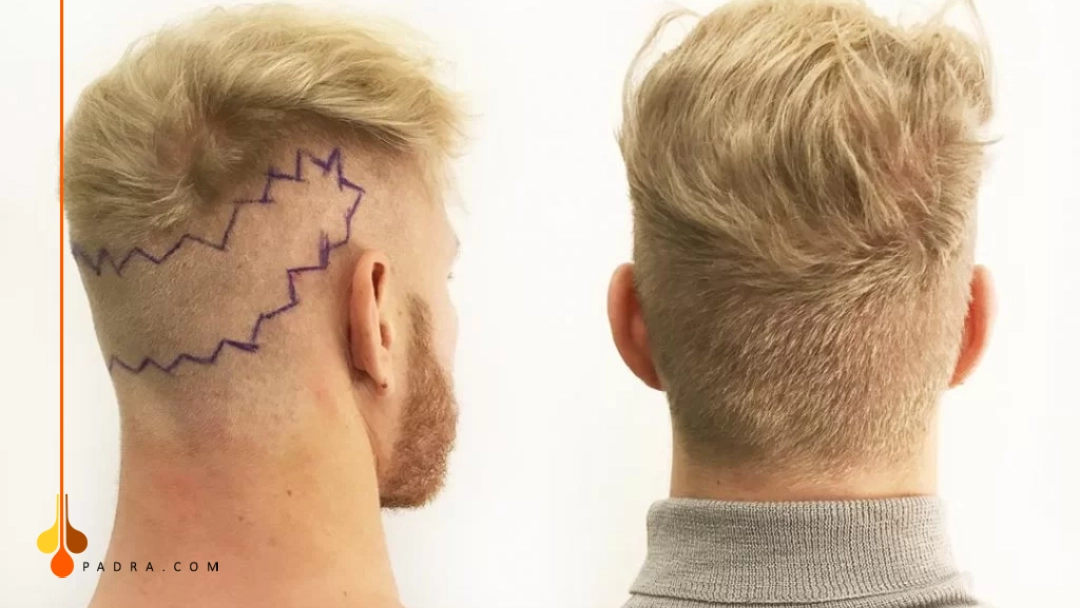 donor area after hair transplant