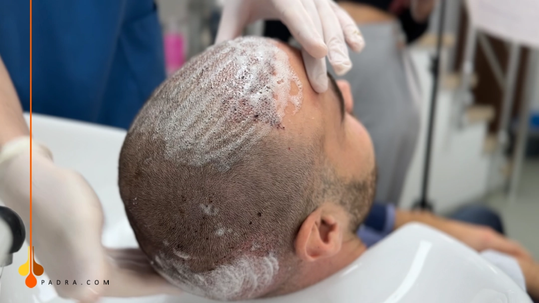 washing the donor area after hair transplant