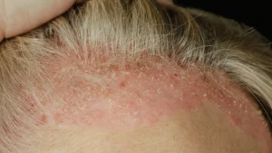 هل تنجح زراعة الشعر لمرضى الصدفية؟