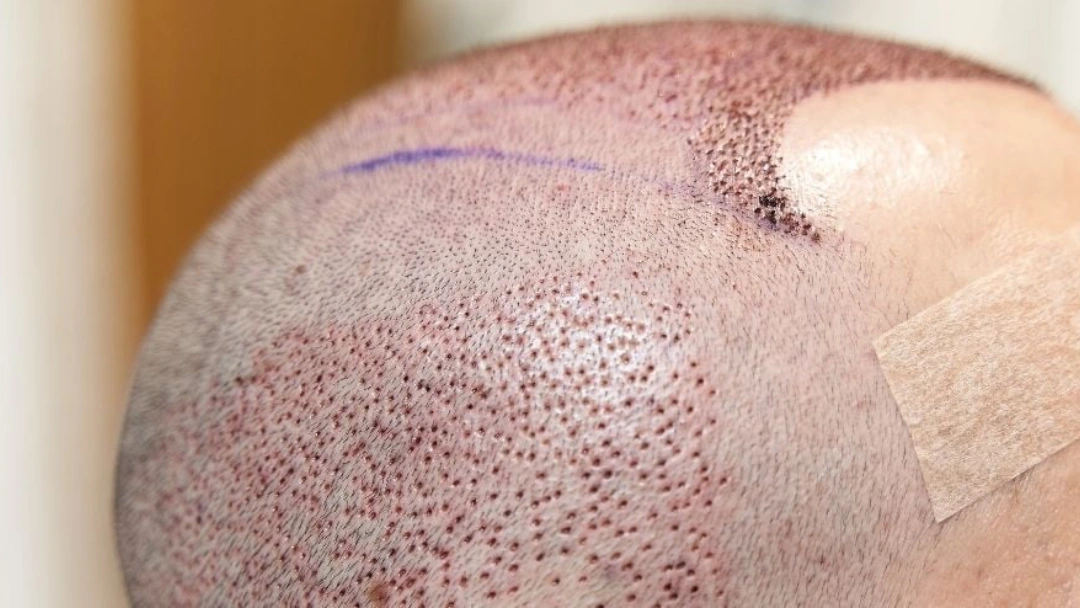 redness after hair transplant