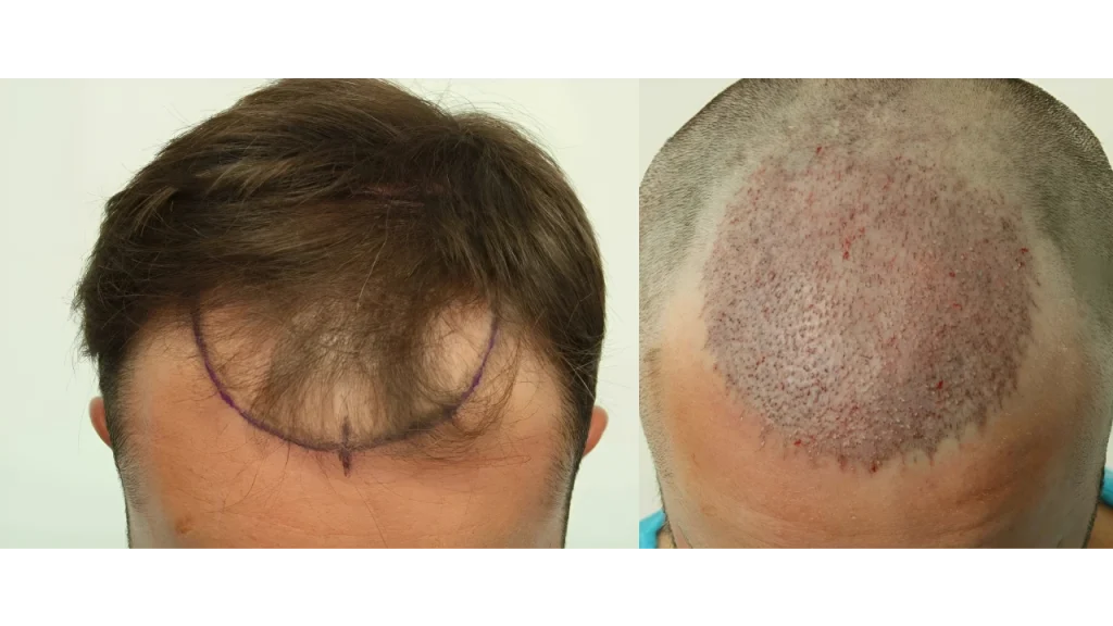 الإسبوع الأول بعد زراعة الشعر