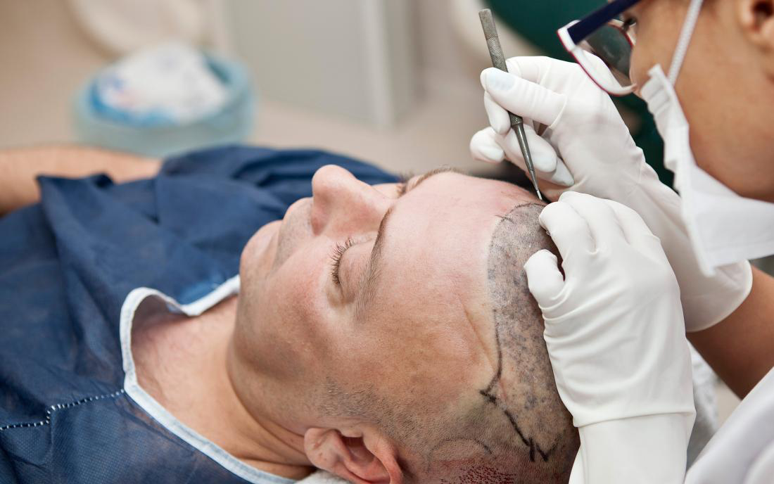 How long do hair transplants take?
