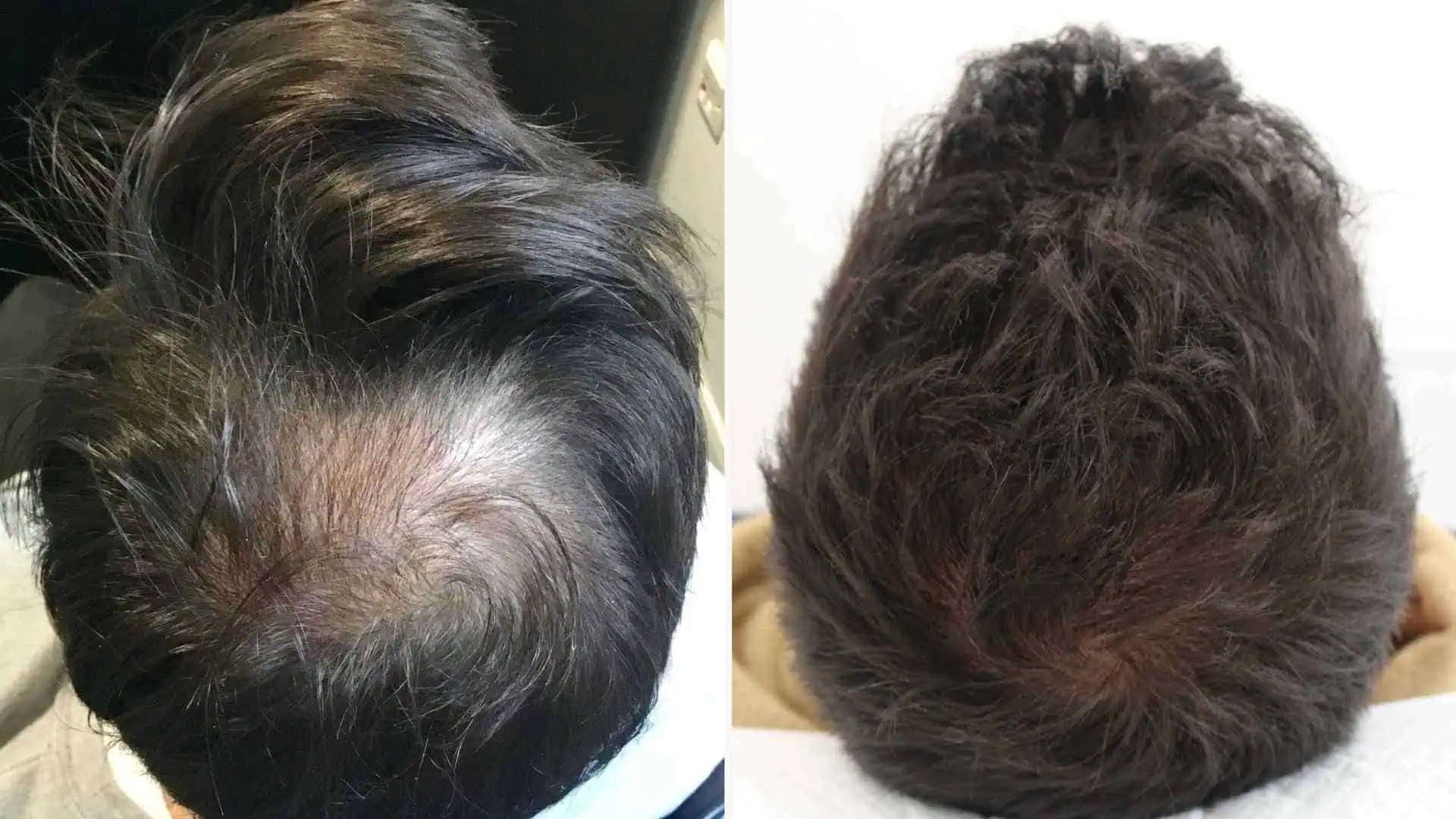 Soft hair transplant instead of coarse hair