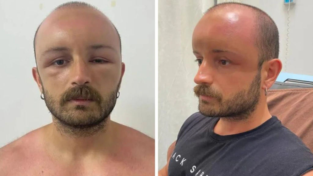 التورم بعد زراعة الشعر