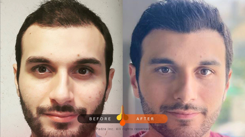 ينصح الأطباء بزراعة الشعر