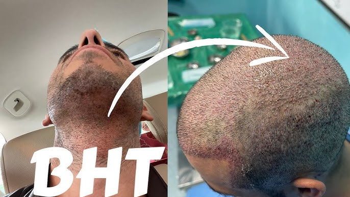 Beard-to-scalp hair transplant