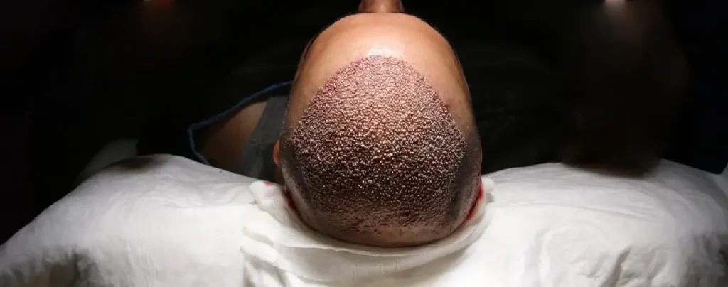 وضع الرأس مباشرة علي الوسادة بعد زراعة الشعر، يعتبر من الأخطاء