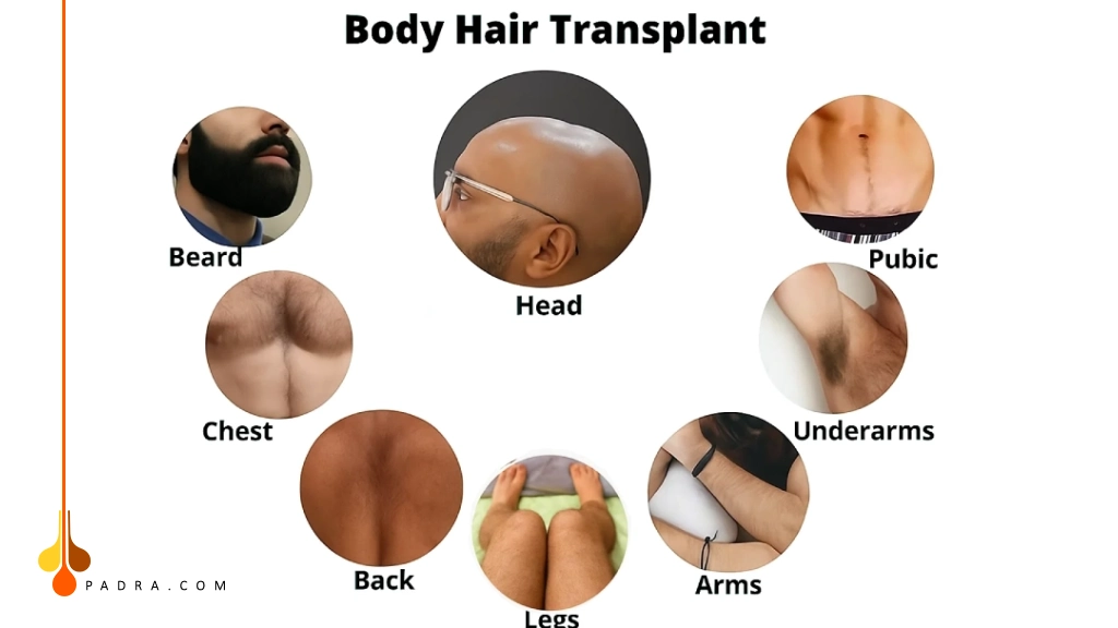 مناطق أخد البصيلات لزراعة الشعر من الجسم