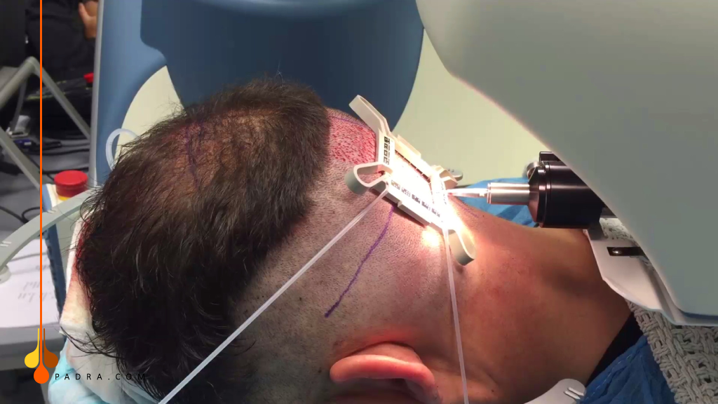 تقنية الروبوت لزراعة الشعر 