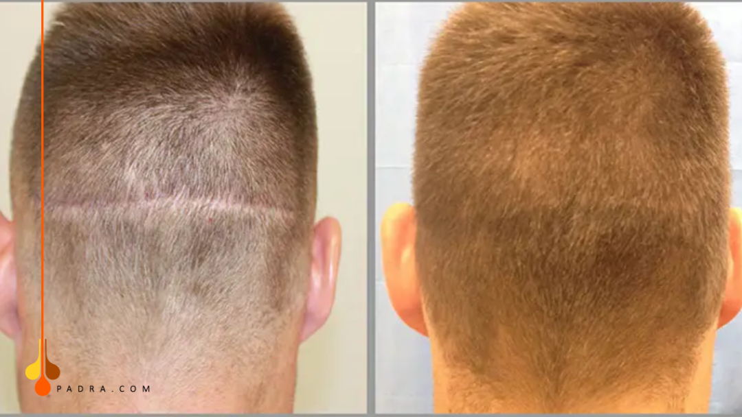 ندبات بعد زراعة الشعر بظريقة fut