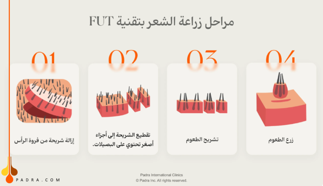 مراحل زراعة الشعر