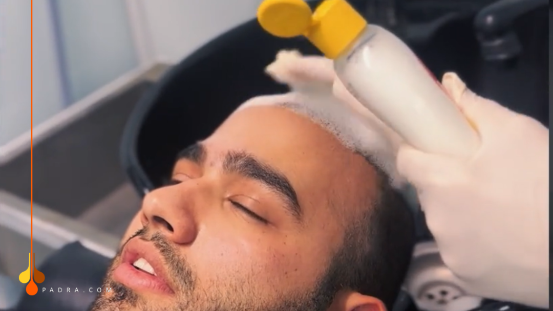 غسل الشعر بعد زراعة الشعر 