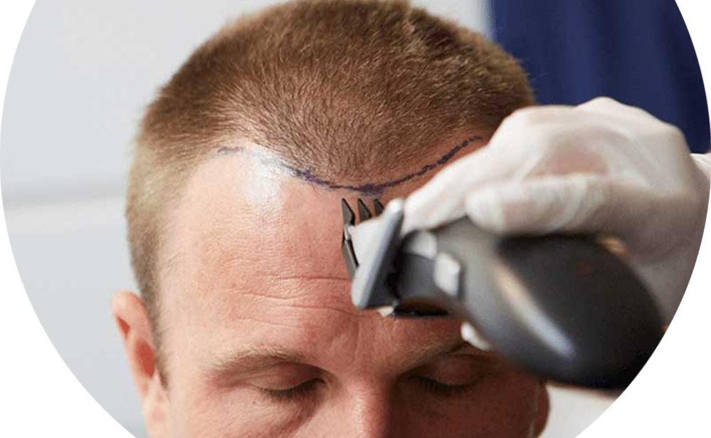 Shaving hair after hair transplantation