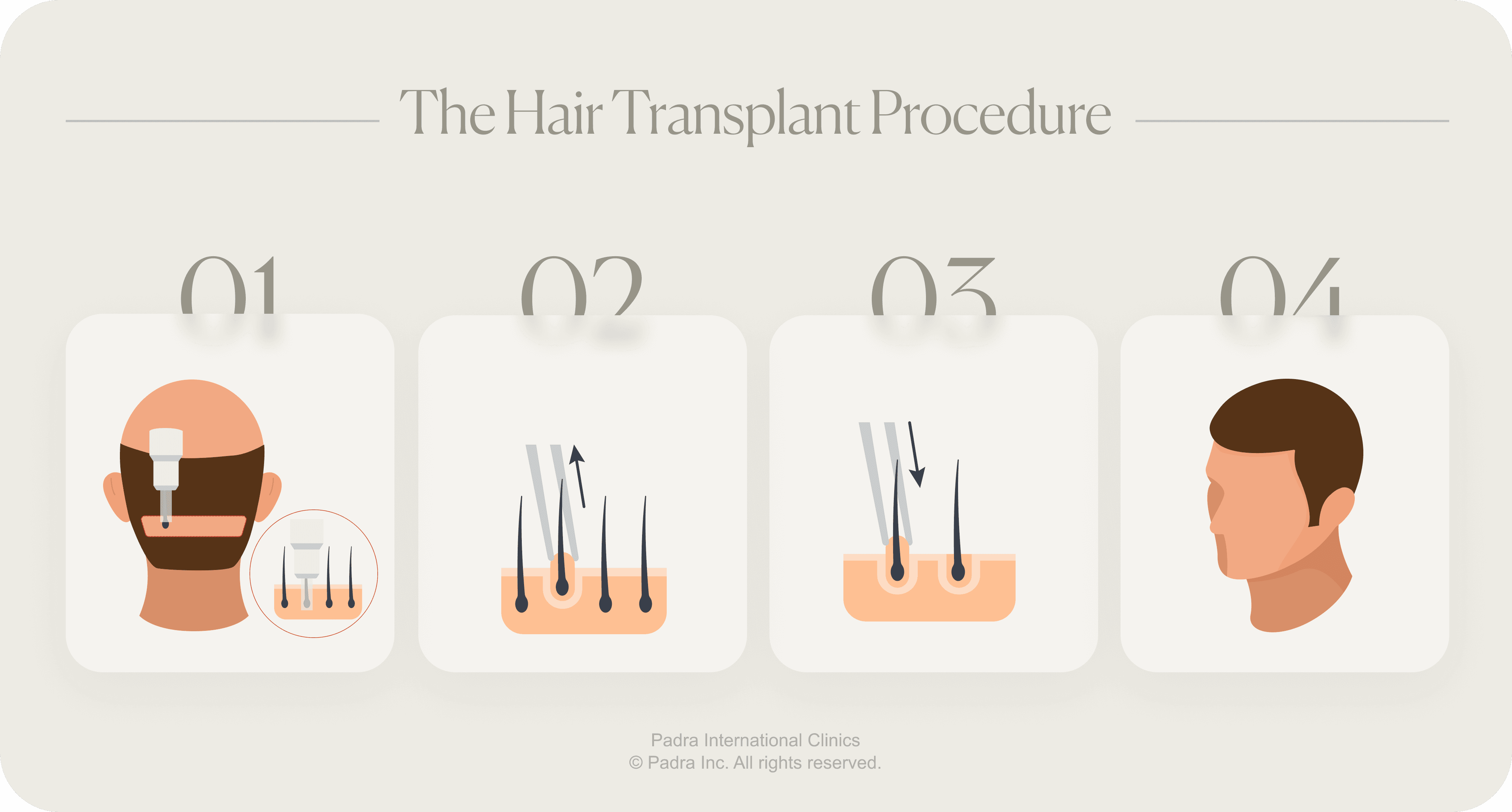 Hair Transplant Procedure