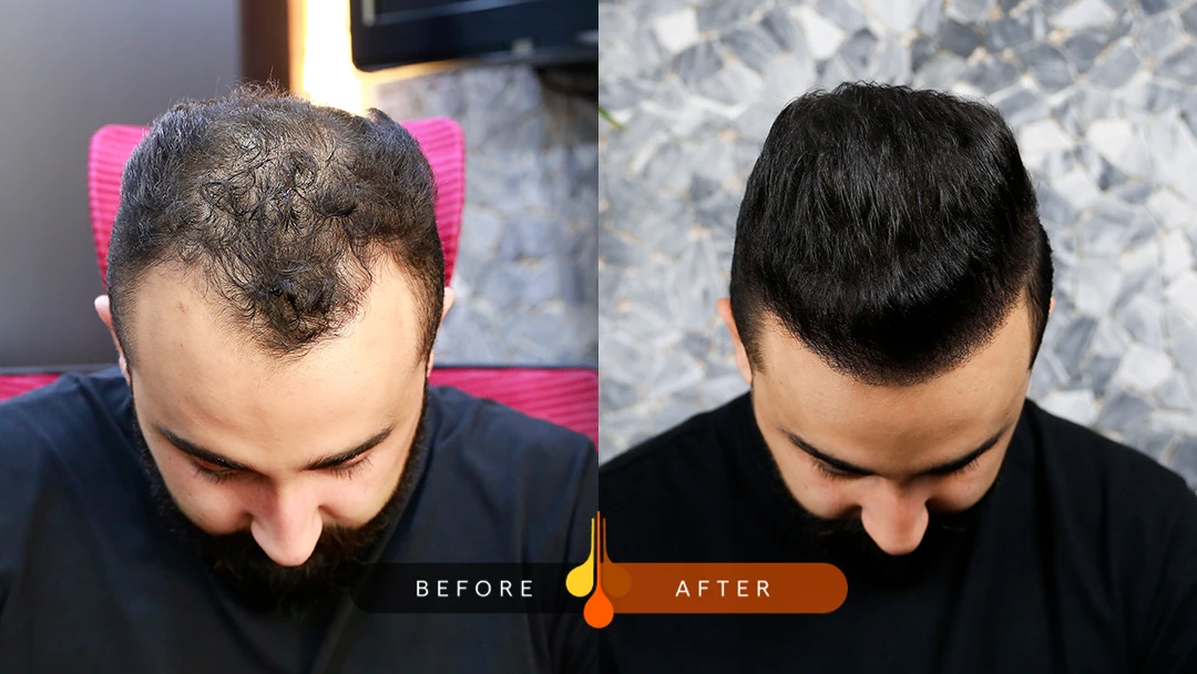 widow's peak hairline transplant before and after