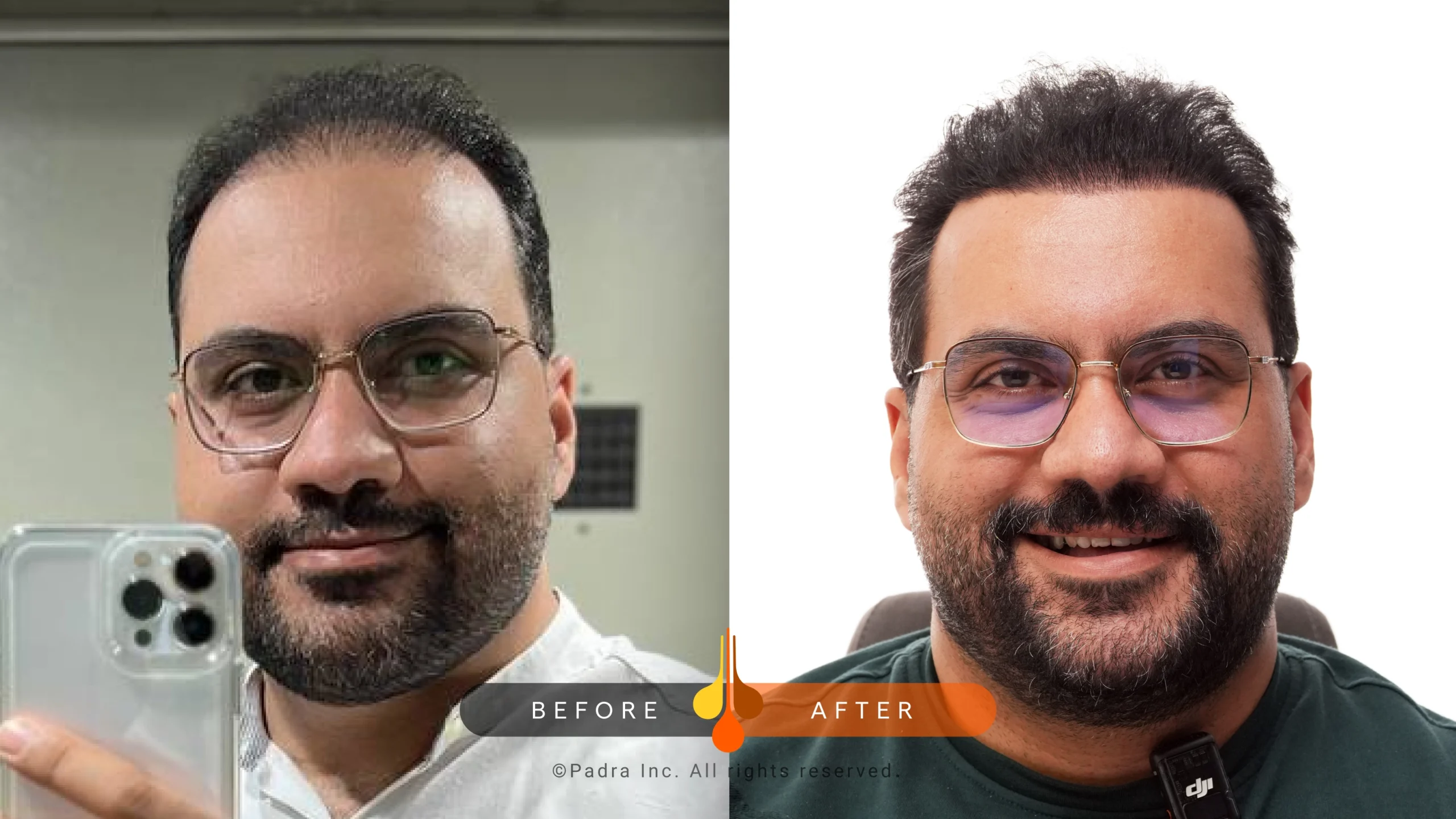 hair transplant before-after