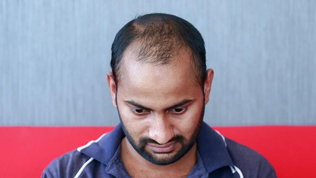 widow's peak hairline