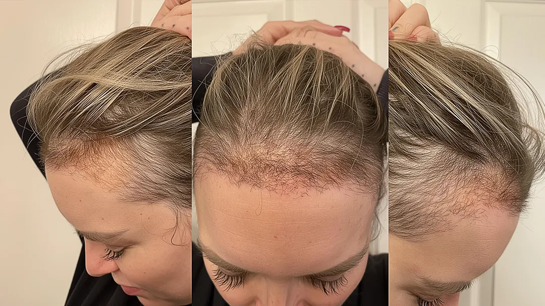 can hair transplant fall out?
