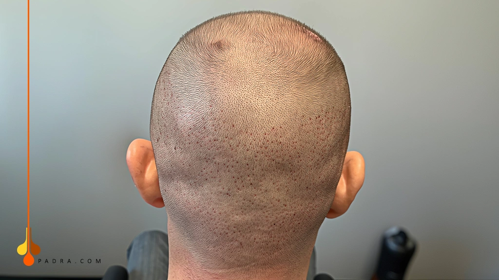 shedding after hair transplant
