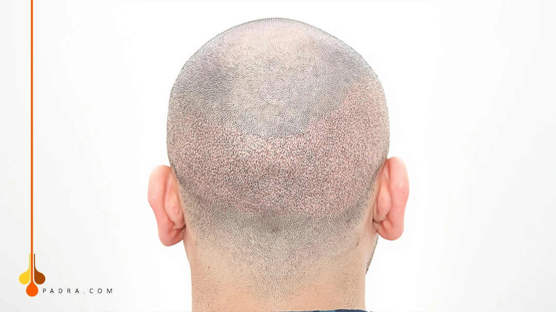 shock loss after hair transplant