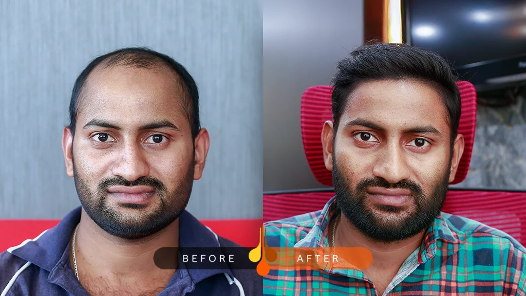 hair transplant before and after