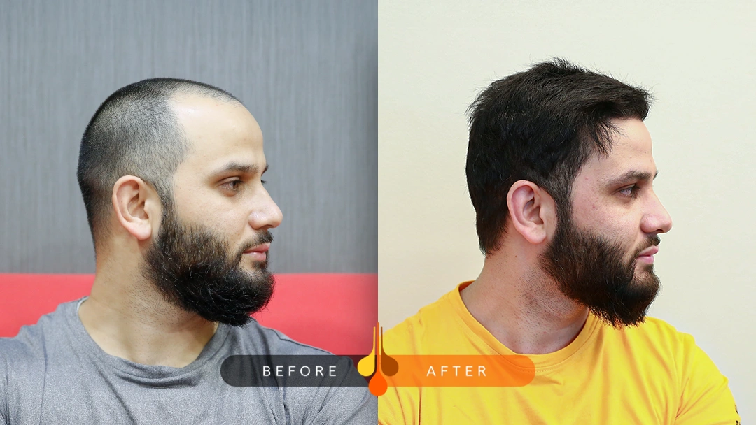 hair transplant after 10 years before and after