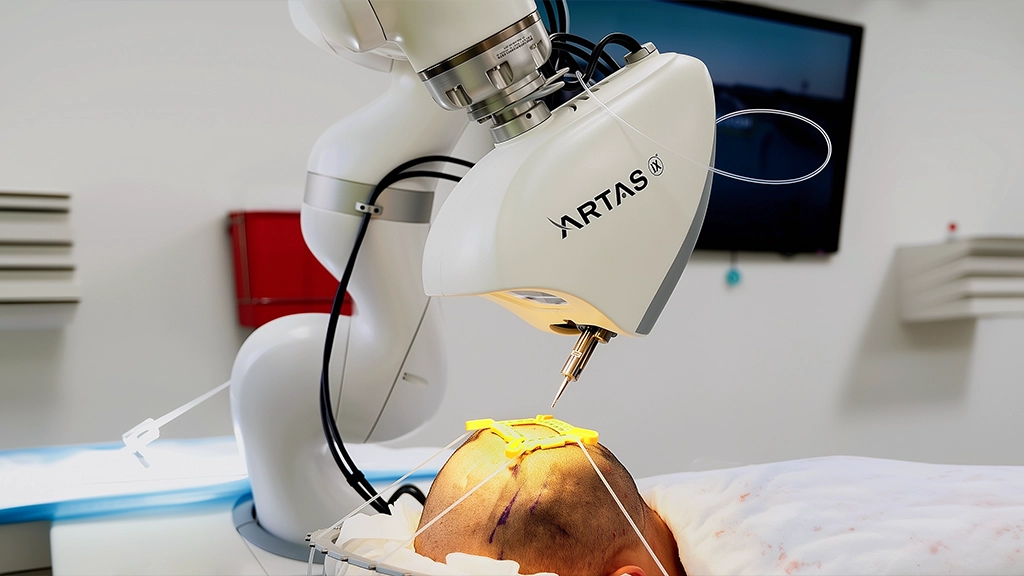 robotic hair transplant