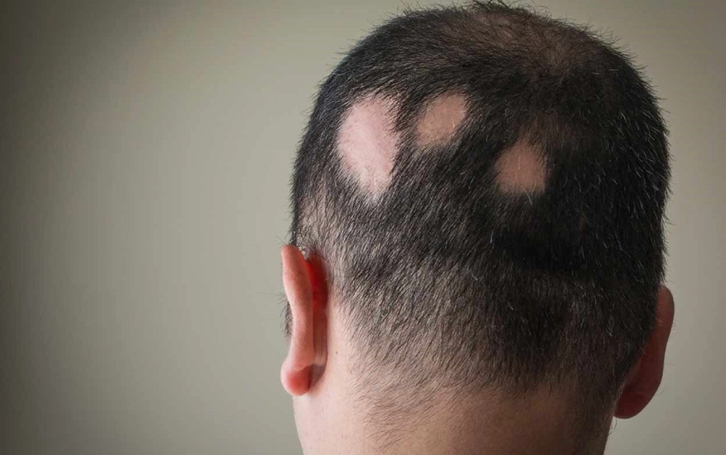 alopecia-areata