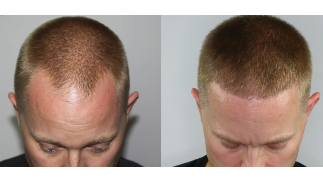 thin hair transplant