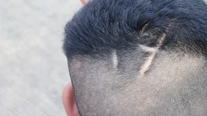 Hair Transplant on Scar Tissue: A Complete Guide to Techniques, Results & Recovery