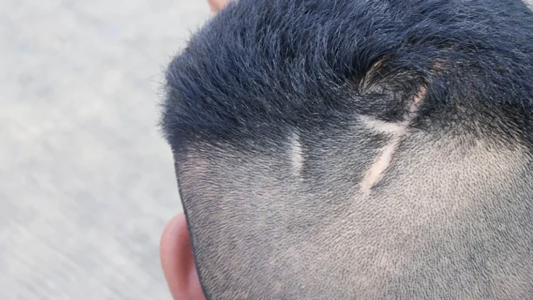 hair transplant on scar tissue