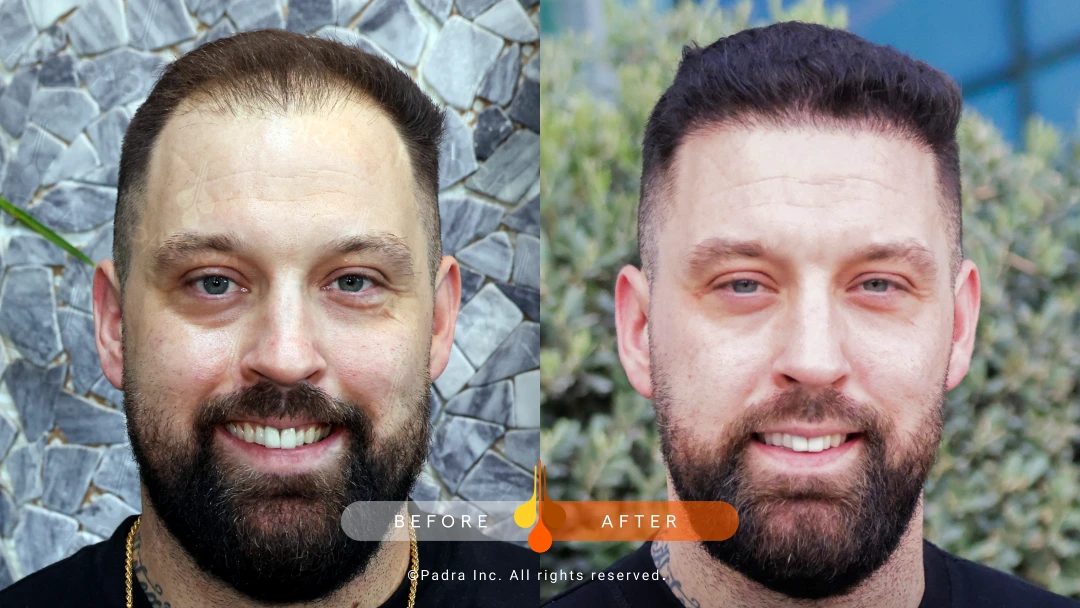 1000 grafts hair transplant before and after