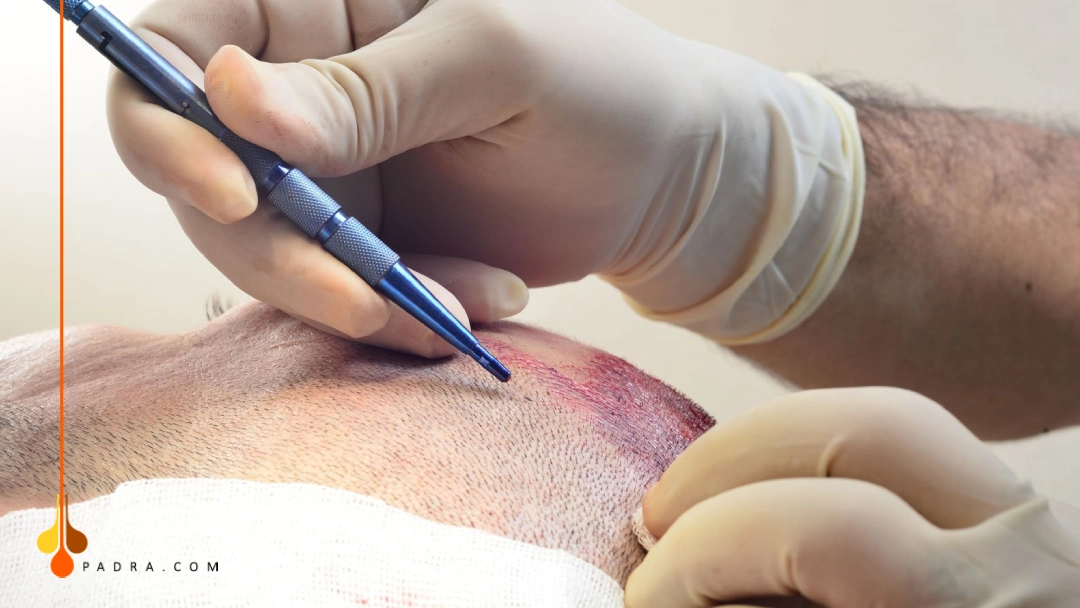 sapphire fue hair transplant