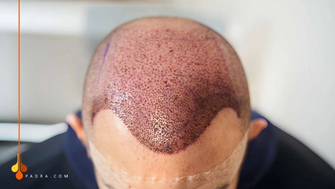 10 days after hair transplant