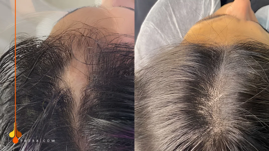 hair transplant into scar before and after