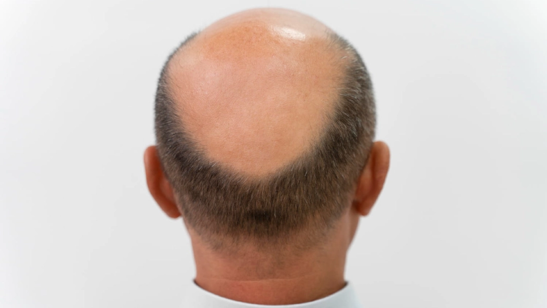 bald hair transplant