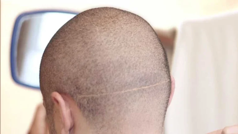 hair transplant scar