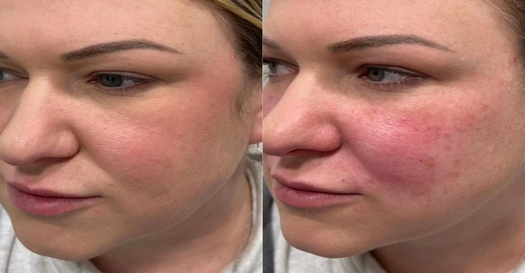 facial filler injection side effects