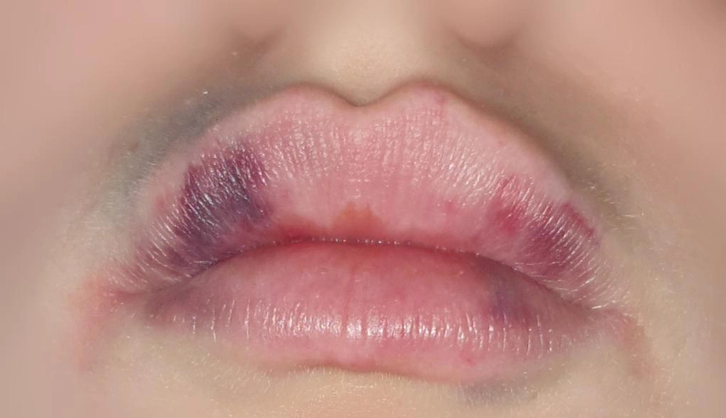 lip-filler-injection-side-effects