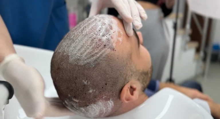 غسل الشعر بعد زراعة الشعر